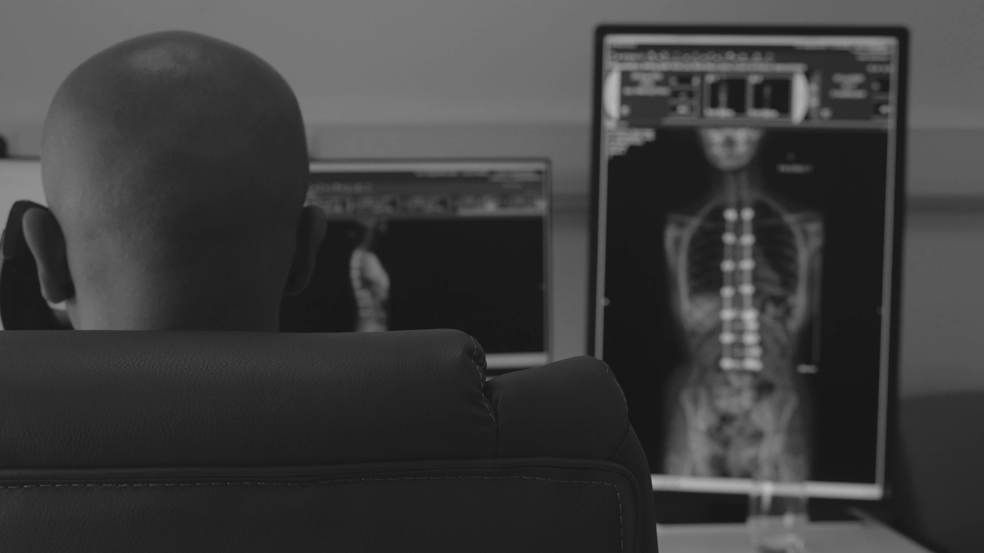 Scoliosis surgery — intra-operative