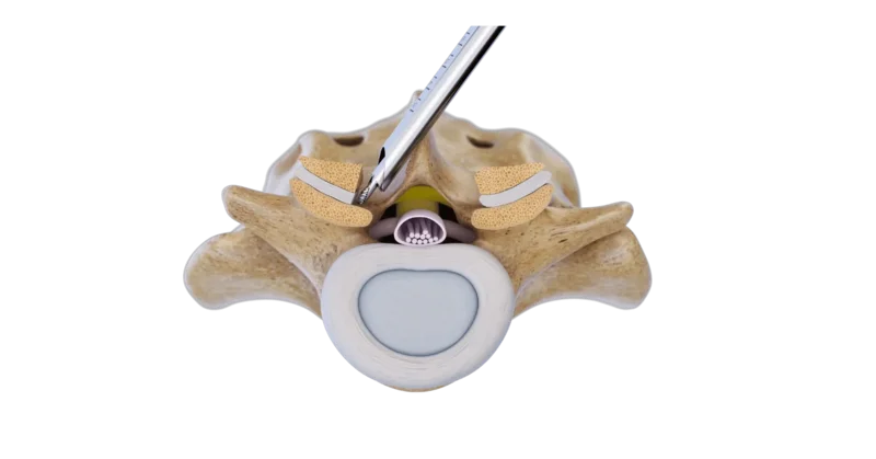 Illustration of the contralateral interlaminar endoscopic foraminotomy approach
