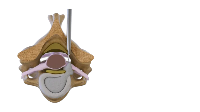 Illustration of the cervical endoscopic unilateral laminotomy for bilateral decompression