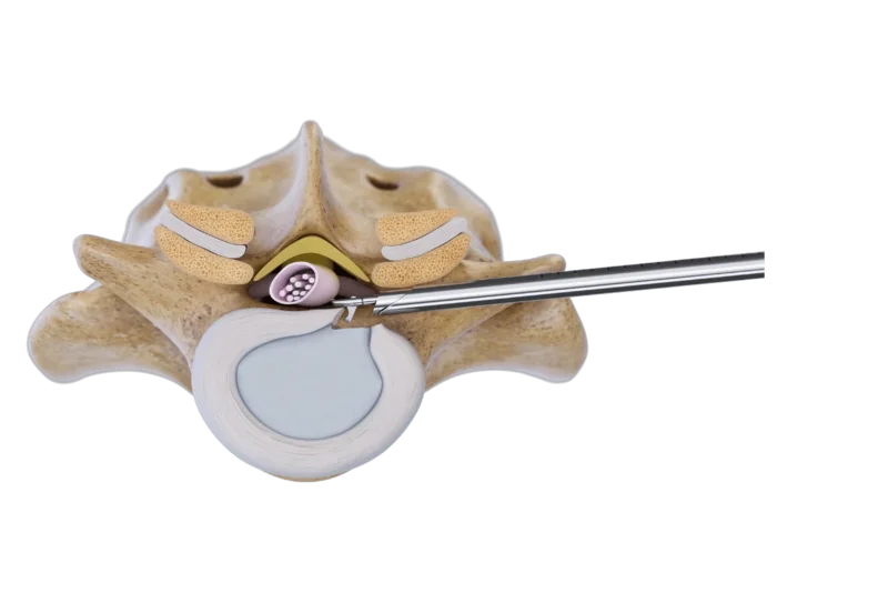 Illustration of the endoscopic revisional discectomy approach