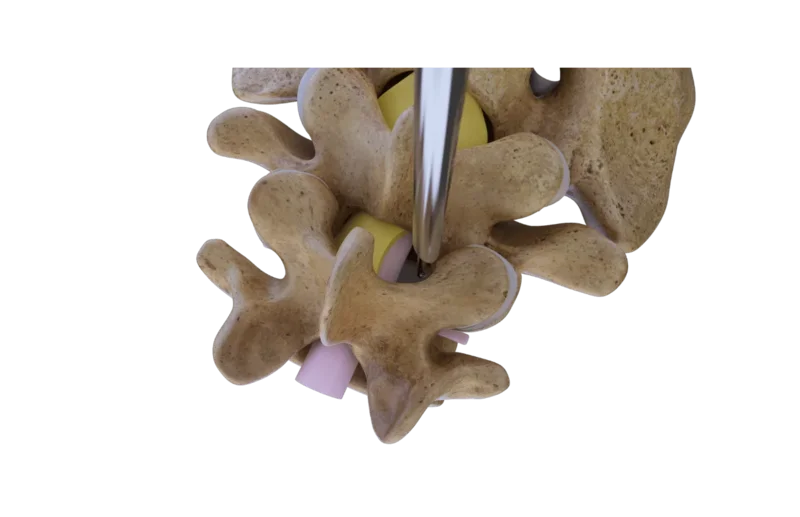 Illustration of the unilateral laminotomy for bilateral decompression technique
