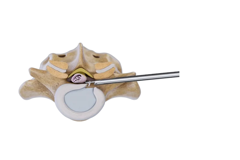 Illustration of the transforaminal endoscopic approach to a lumbar disc