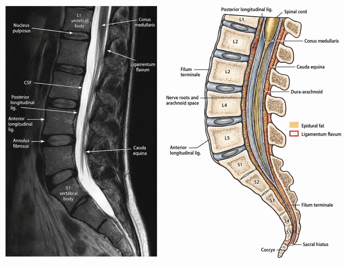 MRI scan alongside an anatomical illustration of the lumbar spine showing the vertebrae, discs, spinal cord, conus medullaris and cauda equina.