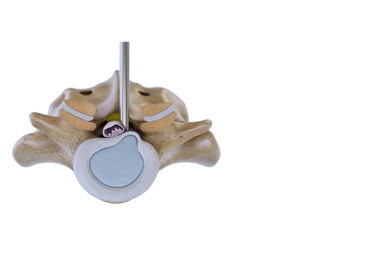Illustration of the interlaminar endoscopic approach to a lumbar disc