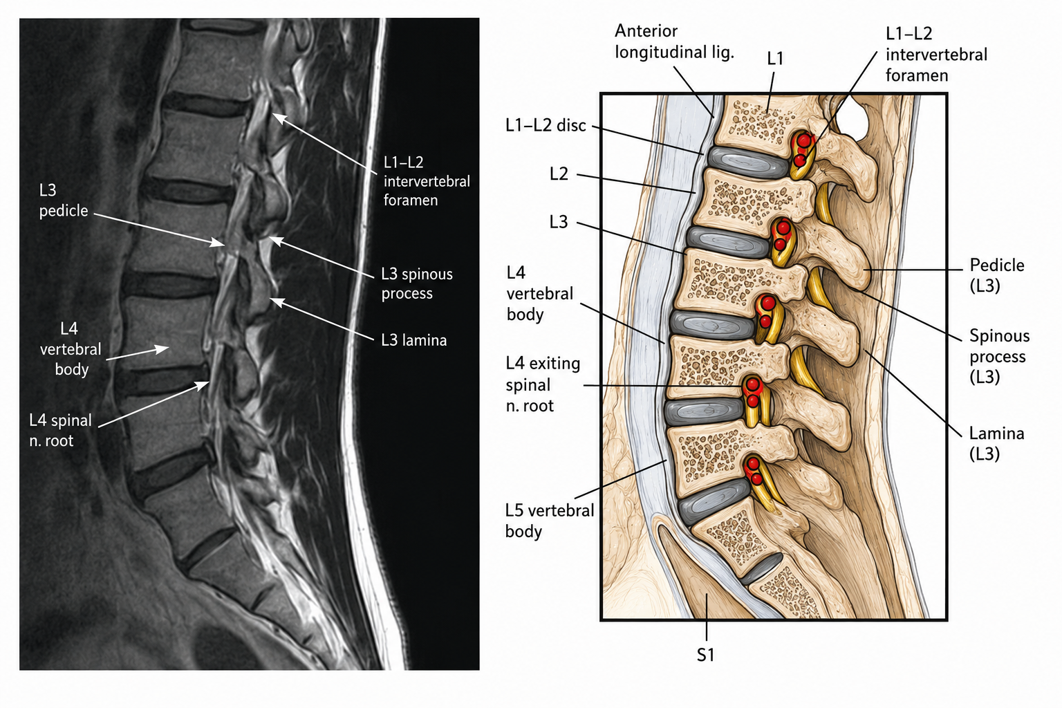 MRI and anatomical illustration showing lumbar vertebrae with the intervertebral foramina and exiting spinal nerve roots labelled.