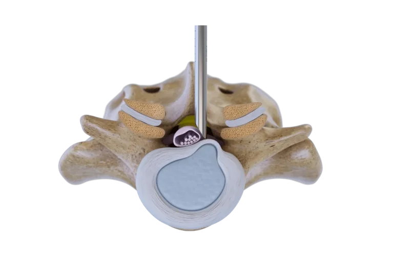 Illustration of the thoracic endoscopic unilateral laminotomy for bilateral decompression